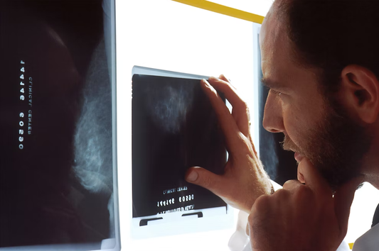 Prostate Cancer: Prostate-Specific Antigen (PSA) Test